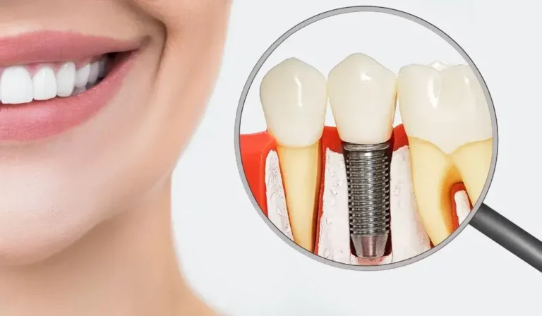 dental implants