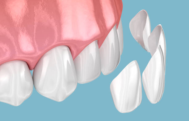 veneers placement on a set of front teeth