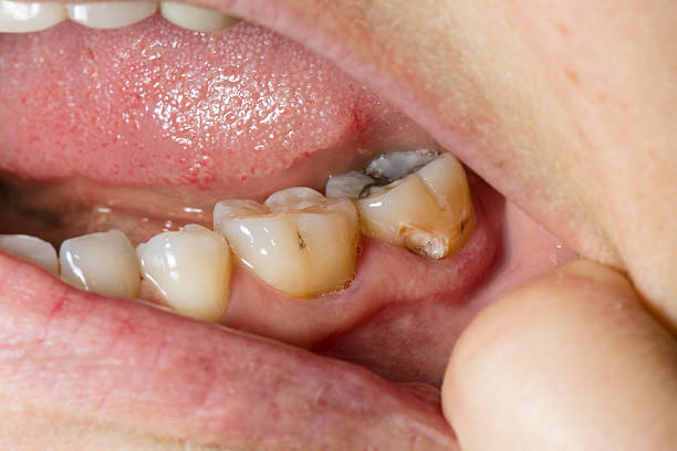 close-up shot of a badly rotten tooth due to cavities