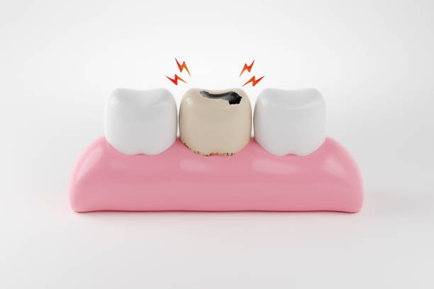 a tooth decay between two healthy teeth