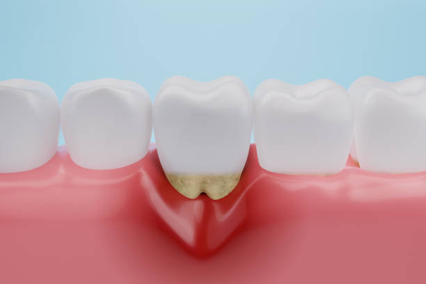 tooth with exposed roots due to cavity