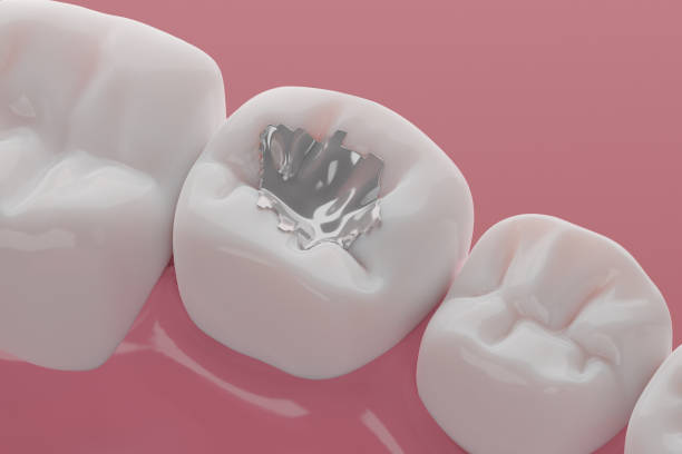 image of a teeth with colored fillings