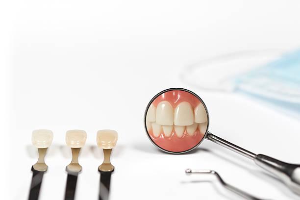 an image showing dental veneers 