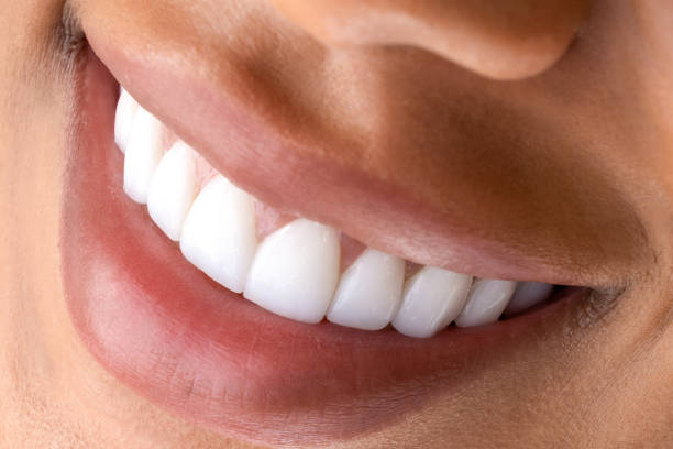close-up shot of teeth with veneers